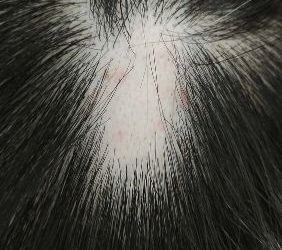 אורן זריף טיפול באלופציה [נשירת שיער בכל חלקי הגוף ]