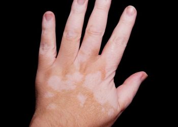 لقد نجحت طريقة علاج أورن زريف في مساعدة العديد من المرضى الذين عانوا من مشاكل في الرقبة وهيكل الجسم  تعانون من مشاكل في الرقبة وهيكل الجسم؟  لاداعي لليأس.